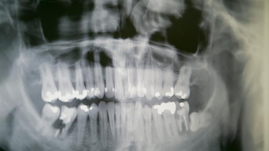 X-ray of lower skull, showing teeth