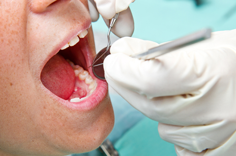 A dentist uses a mirror in a patient’s mouth. News that the COVID virus can infect the mouth and travel in saliva should not keep you away from the dentist.