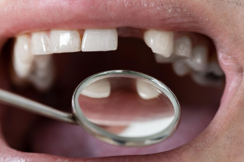 Close-up of a mouth with a front tooth missing